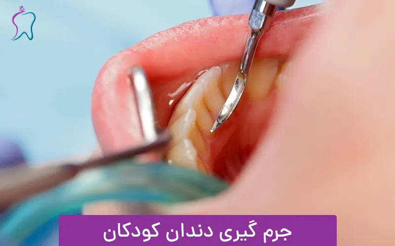 جرم گیری دندان کودکان در غرب تهران