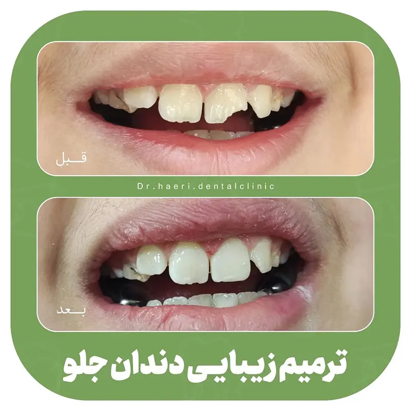 ترمیم دندان شیری کودکان - ترمیم دندان جلو کودکان