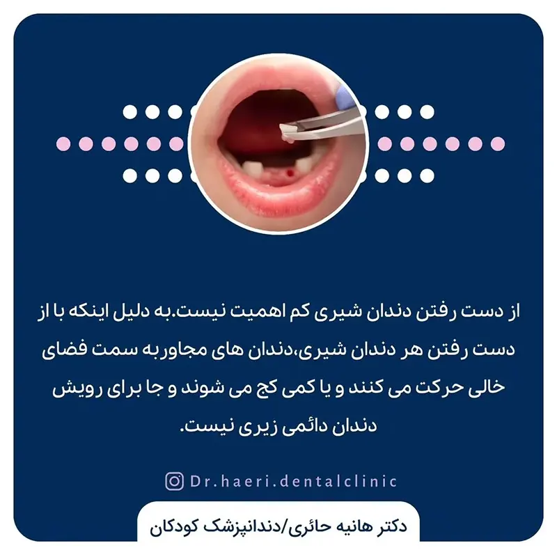 فضانگهدار دندان شیری