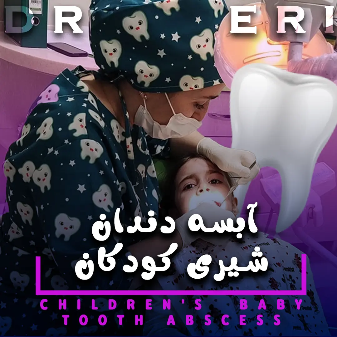 آبسه دندان شیری کودکان