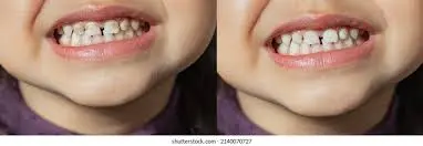 تشخیص پوسیدگی دندان شیری و نیاز به پر کردن