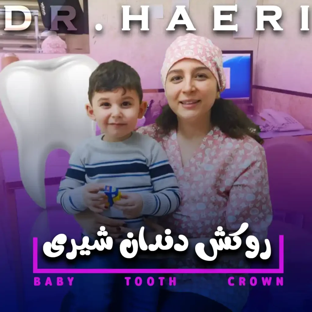 روکش دندان شیری