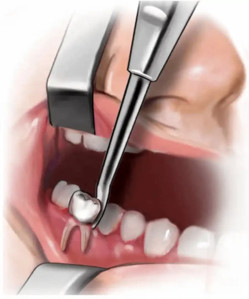 تأثیر کشیدن دندان شیری بر دندان دائمی