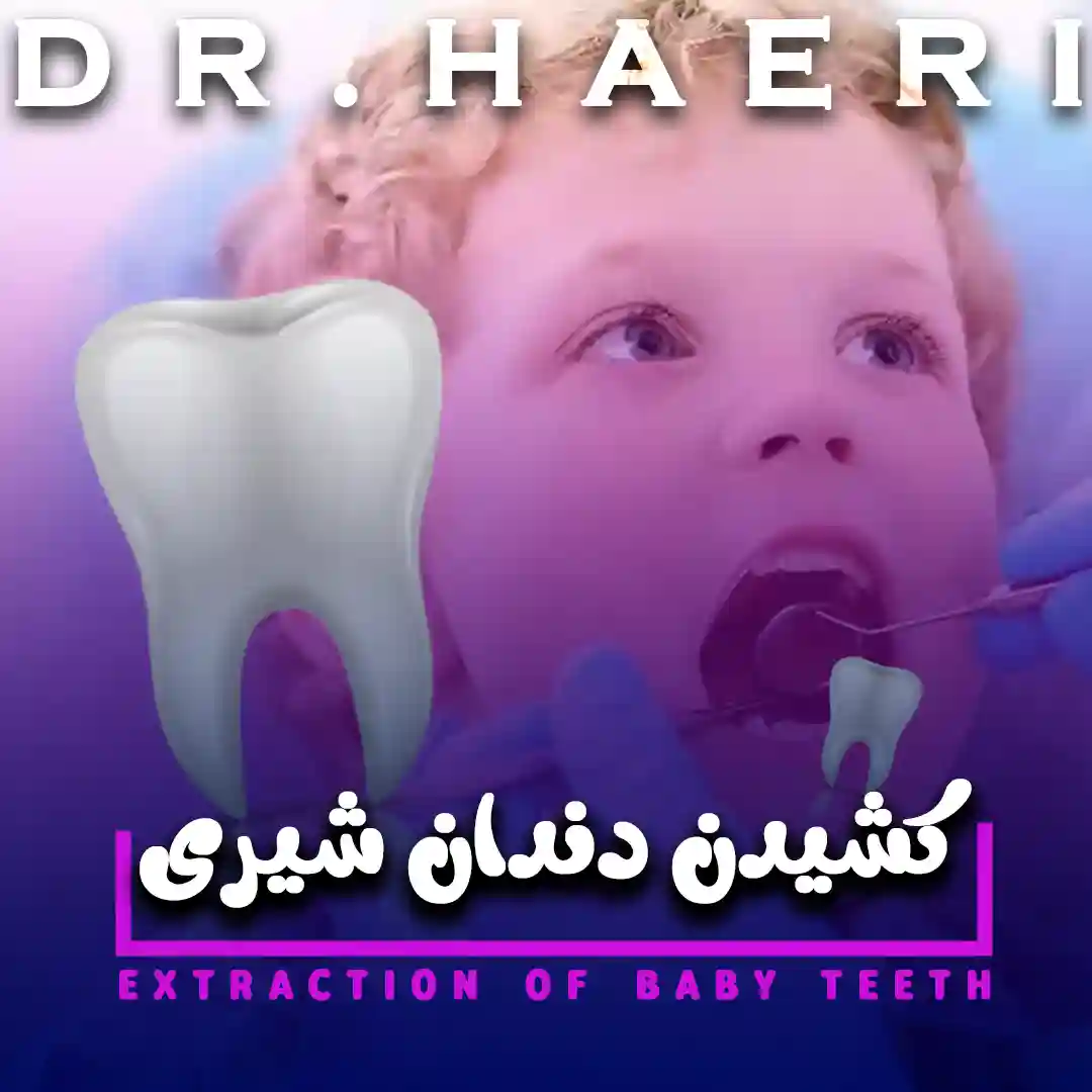 کشیدن دندان شیری