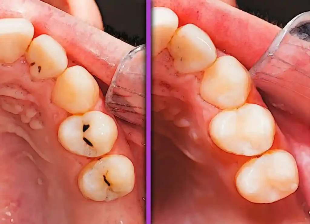 فیشور سیلانت دندان آسیاب کودک