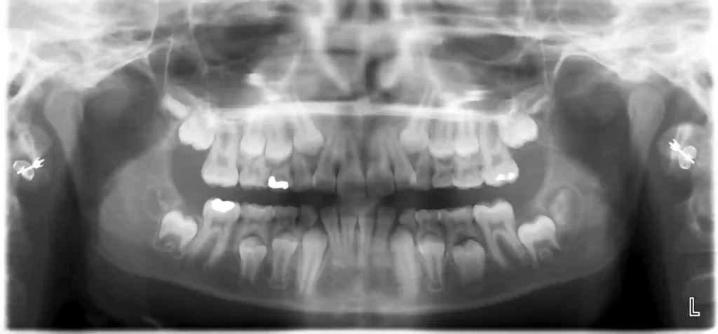 بررسی دندان شیری کودک با رادیوگرافی