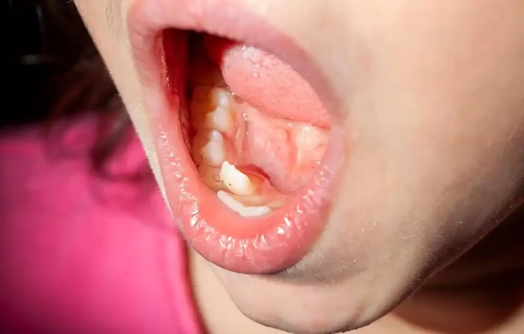 دندان کوسه‌ای در کودکان و رویش دندان دائمی پشت دندان شیری