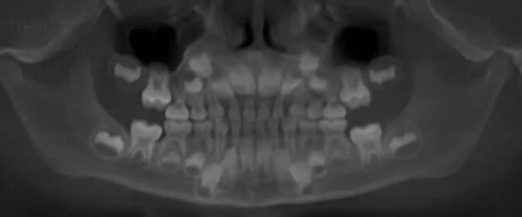 تحلیل ریشه دندان شیری زیر لثه