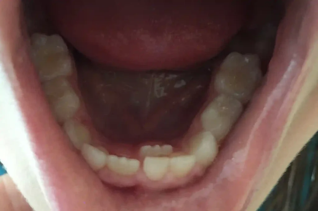 نمونه دو ردیف دندان در کودک