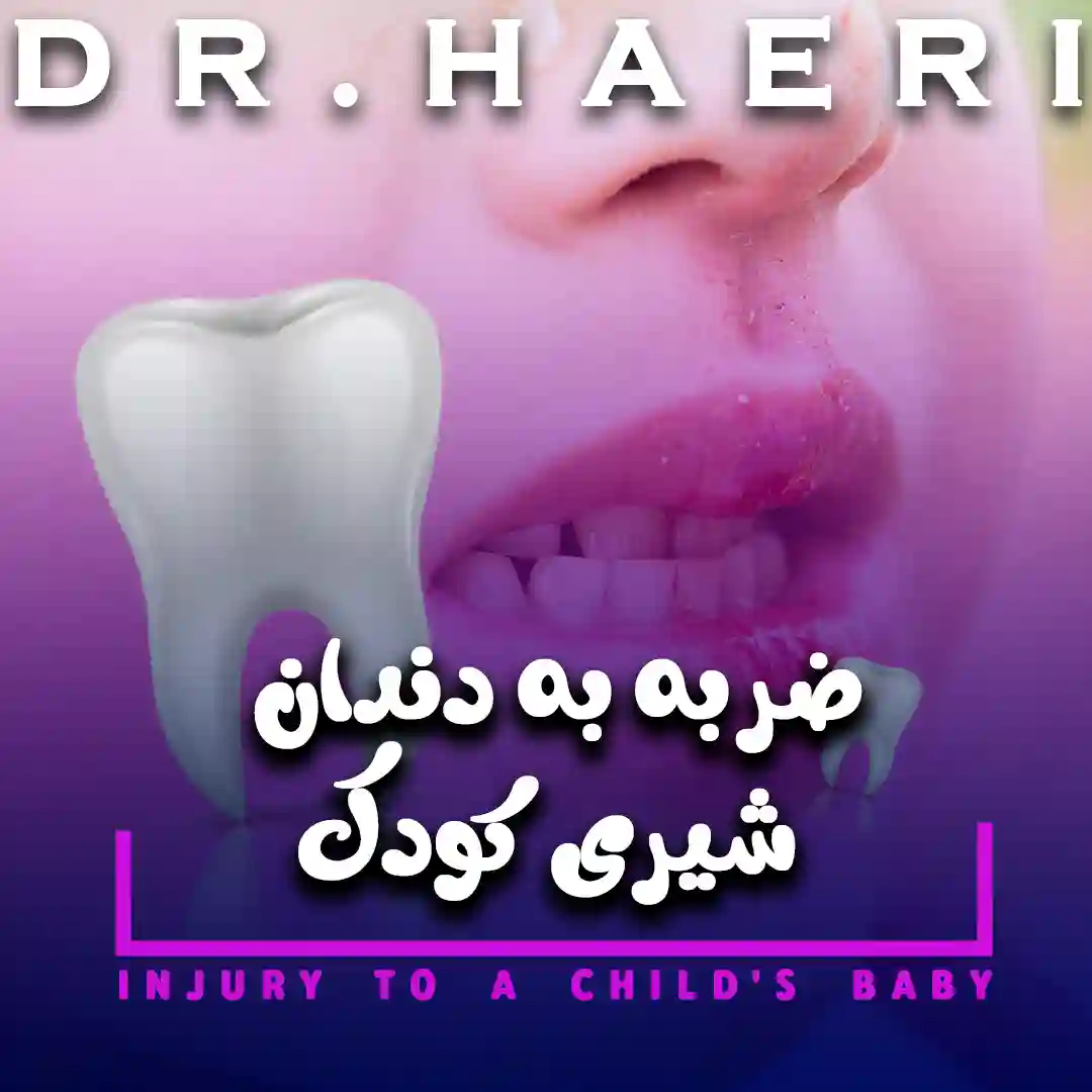 ضربه به دندان شیری کودک1