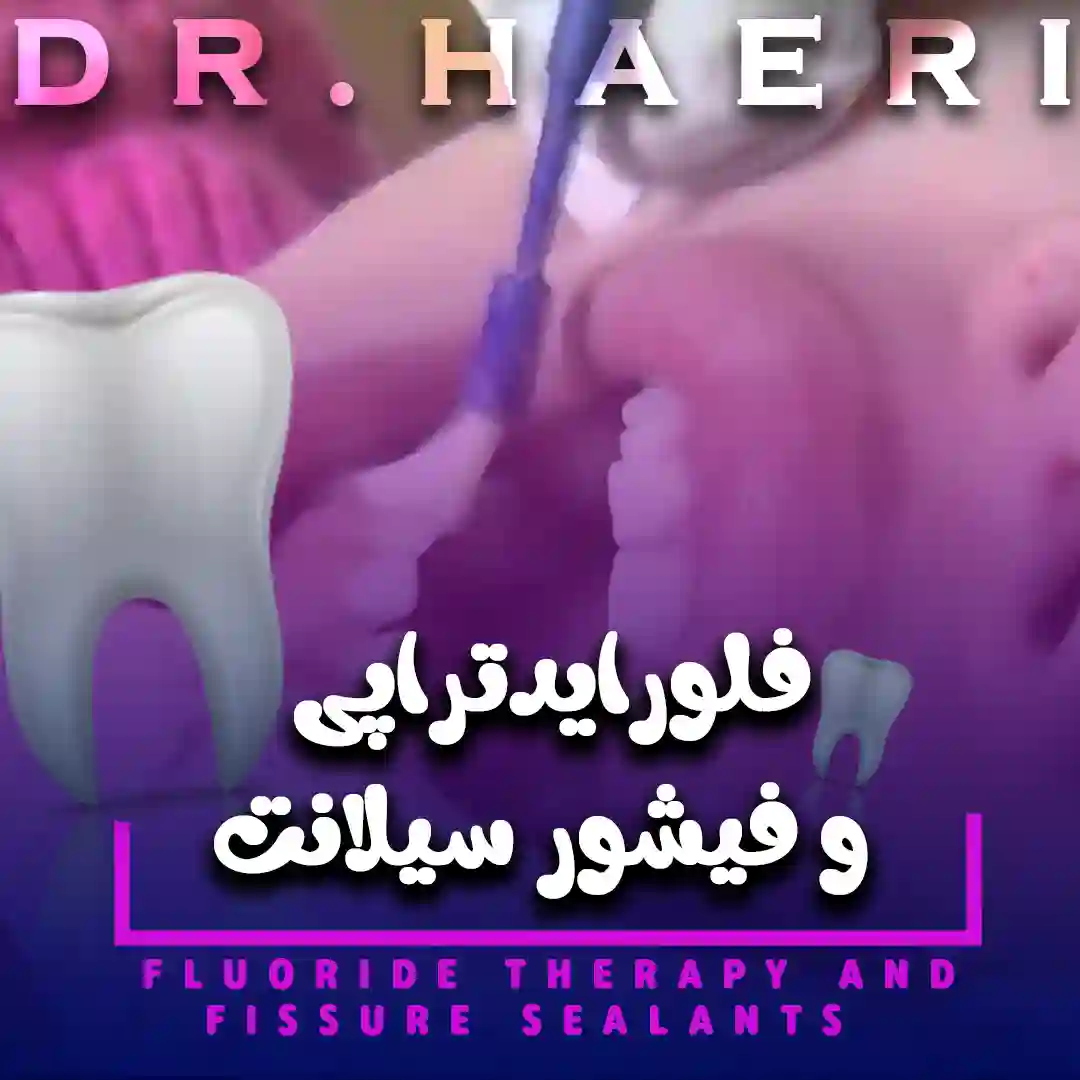 فلورایدتراپی و فیشور سیلانت